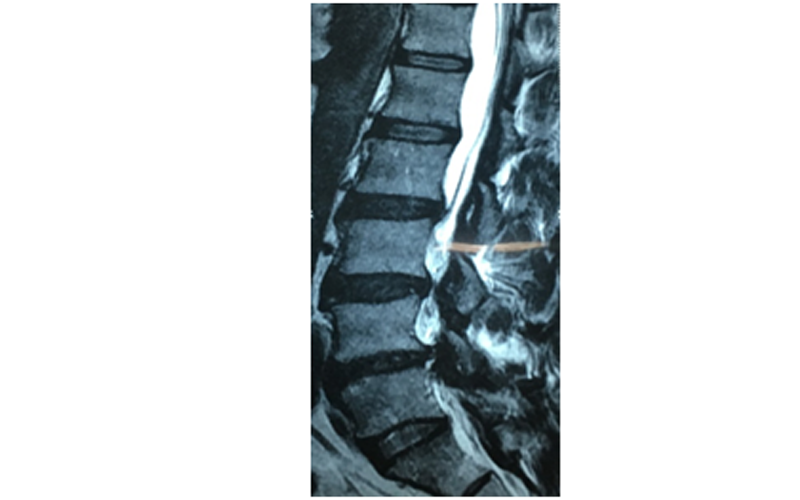 Postero- Lateral Fusion and Decompression for Lumbar Canal Stenosis