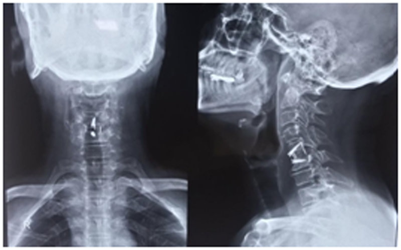 Anterior Cervical Discectomy and Fusion ACDF for Facet Subluxation C5-6
