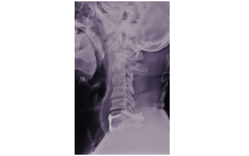 Anterior and Posterior Decompression and Fusion Surgery for C6-7 Dislocation with Myelopathy