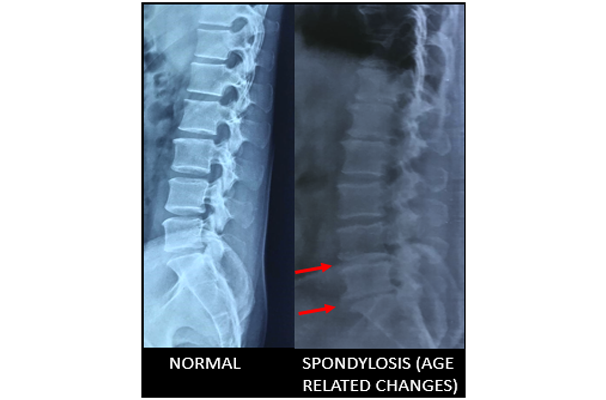 spondylosis xray